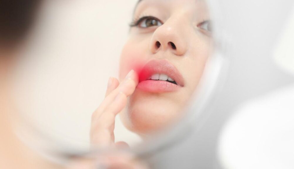 antifungal cream lips